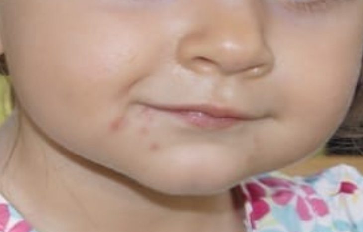 Hand-Fuß-Mund-Krankheit beim Kind mit Ausschlag an Händen und Füßen
